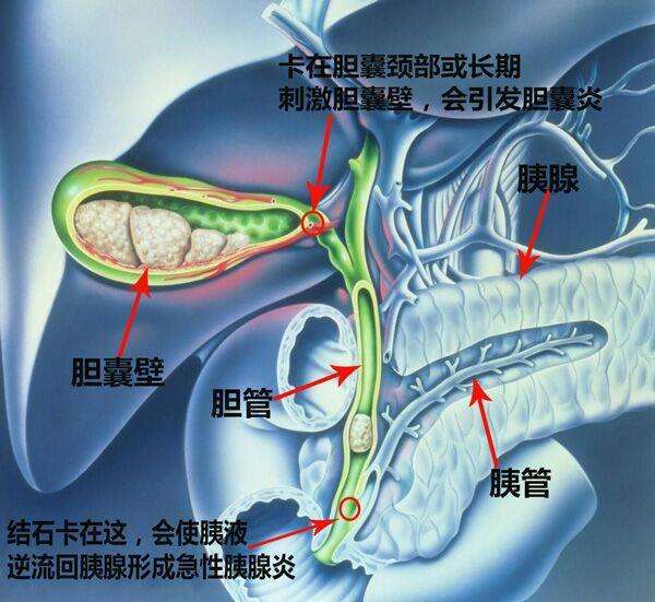 今日科普一下！胆囊藏400多颗结石,百科词条爱好_2024最新更新